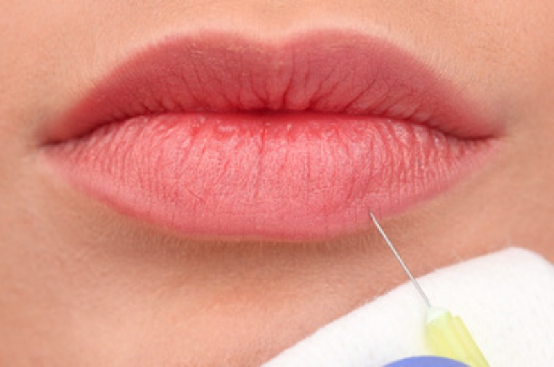 I fillers